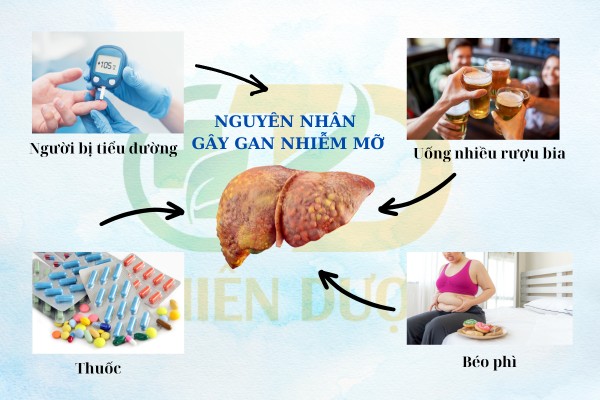 Rượu, bia có phải nguyên nhân gan nhiễm mỡ không?