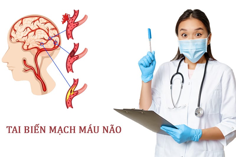 Tìm hiểu các phương pháp điều trị tai biến mạch máu não
