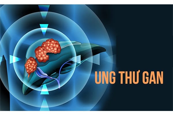 Ung thư gan có thực sự nguy hiểm như chúng ta nghĩ ?