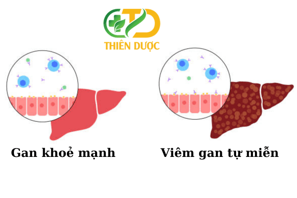 Viêm gan tự miễn có nguy hiểm không?