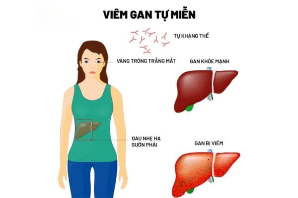 Bệnh viêm gan mãn tính có phòng ngừa được không?